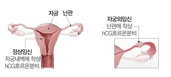 자궁외임신